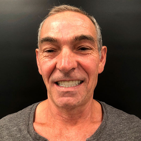 Paciente Pepe C. después de su rehabilitación completa sobre implentes dentales en la clínica de Valencia frente.