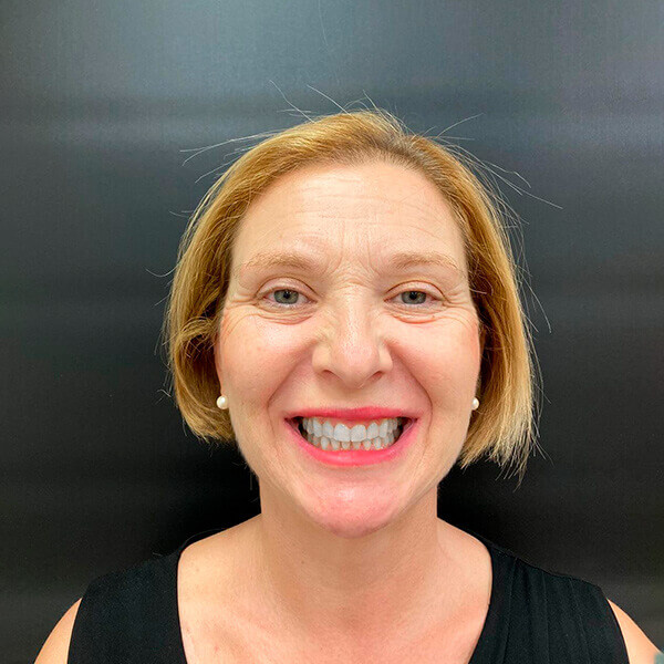 Sobremordida Invisalign después vista frontal completa de la paciente Mari Carmen en la Clínica dental de Valencia