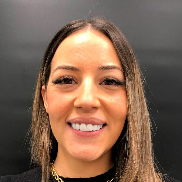 El después de las carillas dentales de Diana en la Clínica dental de Valencia