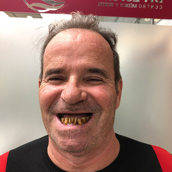 Antes de la rehabilitación oral completa con implantes dentales y prótesis del paciente Vicente