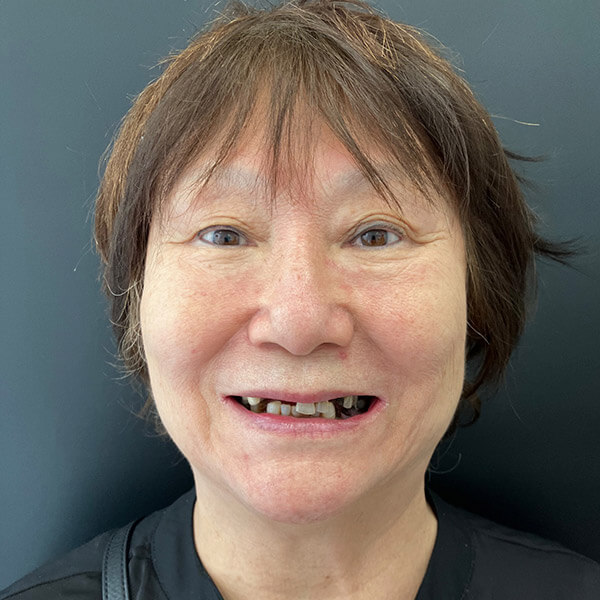 El antes de los implantes dentales All on Six con coronas de zirconio de Chiu